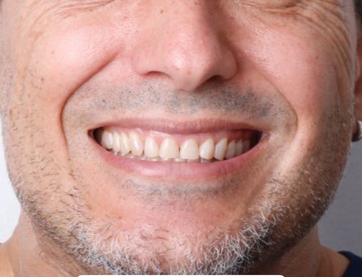 Antes del diseño de sonrisa